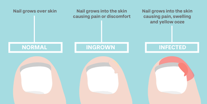 Ingron Toenail Diagram explanation 